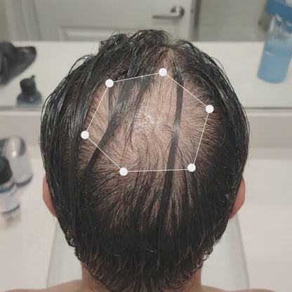 Haar-Mikroinfusions-System™